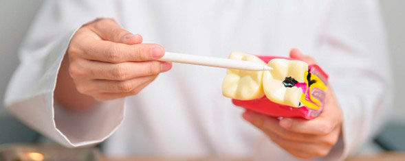 Modelo dental con caries señalado por un odontólogo